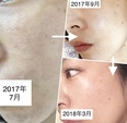 【毛穴ケア】には幹細胞化粧品！